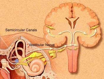 Vestibular Paroxysmia - Vestibular Disorders Association