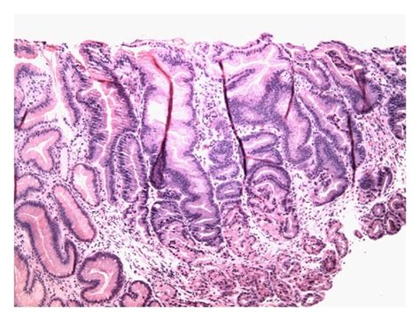 Third EGD shows persisting foveolar hyperplasia (a), erosions but... | Download Scientific Diagram