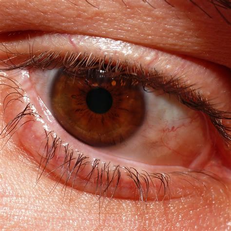 Red Eyes May be a Tell-tale Sign of Coronavirus | Doctor Bob