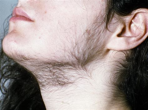 Hirsutism in Polycystic ovary syndrome