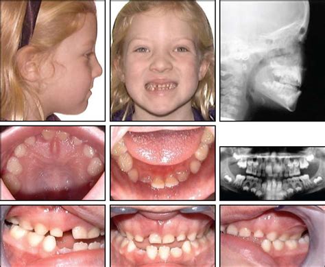 Early Treatment of Skeletal Class III Open Bite with the Tandem Appliance - JCO Online - Journal ...