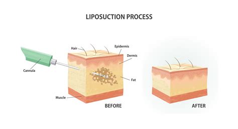 Tumescent Liposuction Benefits - Orange County, CA Cosmetic Fat Removal