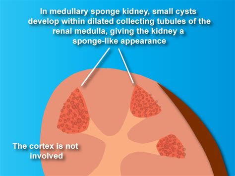 Pin on Medullary Sponge Kidney Disease Support (msk)