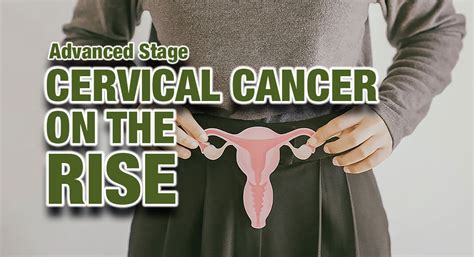 Advanced Stage Cervical Cancer on the Rise - Mega Doctor News