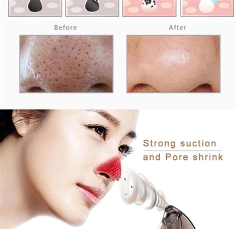 Home Microdermabrasion Machine Nose Pore Vacuum Cleaner Blackhead ...