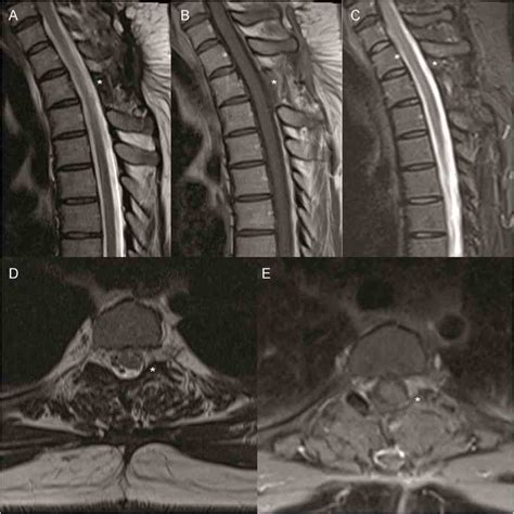 T2-weighted (A, D) and STIR (C) images show a hyperintense lesion with... | Download Scientific ...