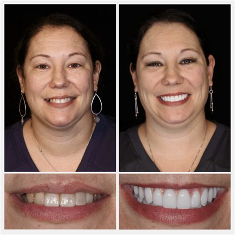 Dental Implants In Houston Transform Another Smile - SmileTexas®