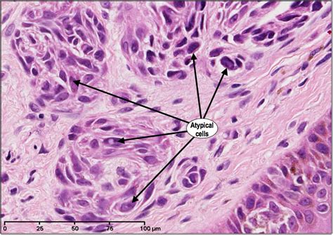 HistoQuarterly: SUPERFICIAL SPREADING MALIGNANT MELANOMA | Histology Blog