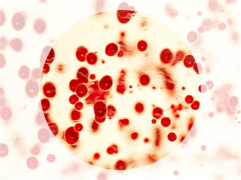 Your guide to Hematuria or Blood in Urine