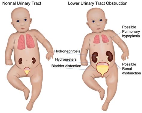 Fetal Lower Urinary Tract Obstruction - Los Angeles Fetal Surgery