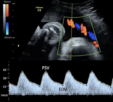 Umbilical Artery Ultrasound