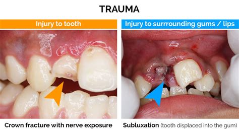 Dental Trauma - Oralcare