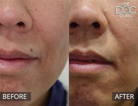 Skin Mole Removal in Melbourne | The DOC Cosmetic Clinic