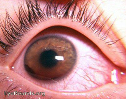 Blood In The Eye: Managing Hyphema - Eyedolatry