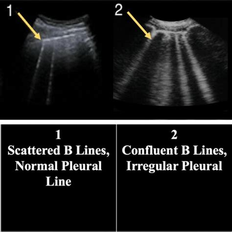 Lung ultrasound score and Borg dyspnea scale correlation at rest.... | Download Scientific Diagram