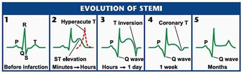 Pin by Jocelyn Freeman on medical | St elevation, Emergency medicine, Human anatomy and physiology