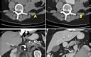 Intraoperative Abdominal Aortic Aneurysm Repair and Its Complications From an Anesthesia ...