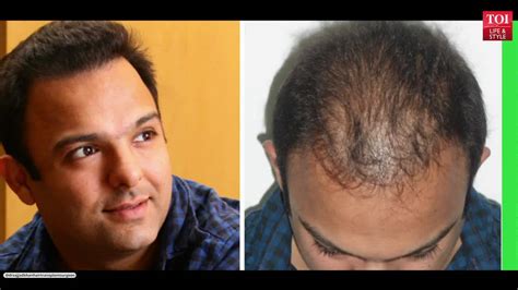 Top 105+ hair transplant before after india latest - ceg.edu.vn