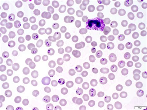 Pathology Outlines - Plasmodium falciparum