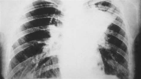 Blastomycosis, rare lung infection, found in 'cluster' of children on ...