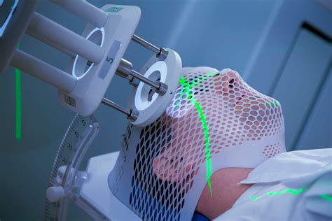 Stereotactic Radiosurgery in SCLC With Brain Metastasis - Cancer Therapy Advisor