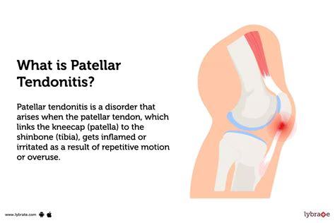 Patellar Tendonitis: Causes, Symptoms, Treatment and Cost