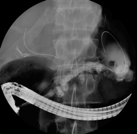 Dilated Wirsung duct communicating with the pseudocyst. | Download ...