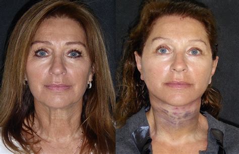 Linda; 59, Facelift, neck lift, platysmaplasty surgery - Dominic Bray