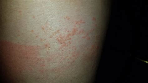 HIV rash? Please help. : r/STD