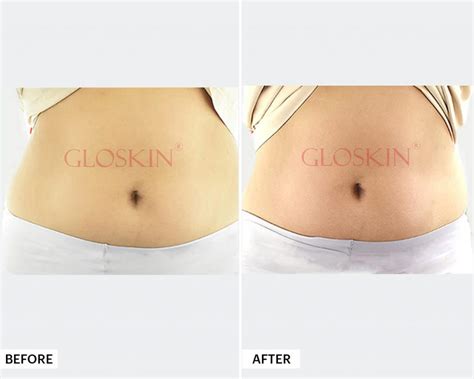 Body Contour - Gloskin Aesthetic Clinic