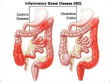 ileitis – Liberal Dictionary