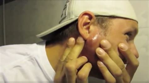 This Pimple Popping Video Is the Grossest on the Internet — Watch Here!