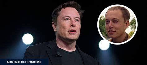 Elon Musk Hair Transplant 2024 - Smile Hair Clinic