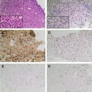 Pre-treatment omental core biopsy specimen. (A) The tumour showed... | Download Scientific Diagram