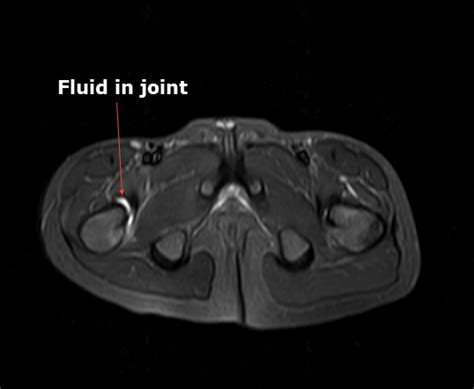 Transient Synovitis of Hip | Bone and Spine