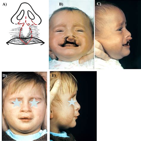 Long-term Observations and Own Concepts in Cleft Lip and Palate Repair