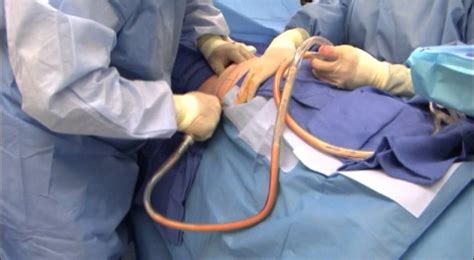 Smart Lipo Triplex Surgery - YouTube