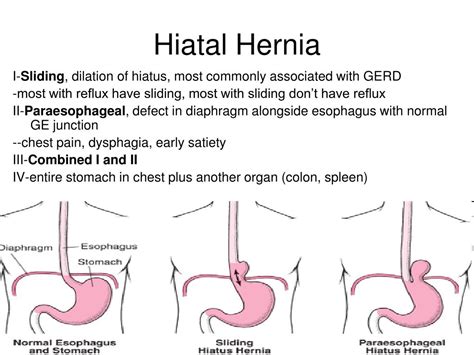 Esophagus Hiatal Hernia Surgery