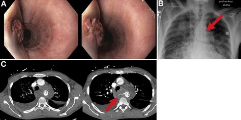 Aortoesophageal Fistula Is no Ordinary Ulcer - Clinical Gastroenterology and Hepatology