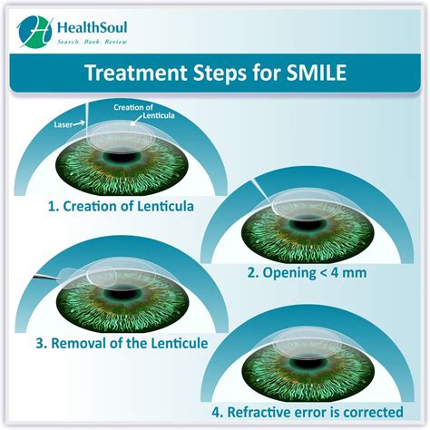 SMILE Laser Surgery for Vision Correction - Healthsoul