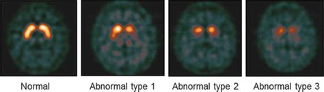 Dopamine Transporter Imaging | Neupsy Key