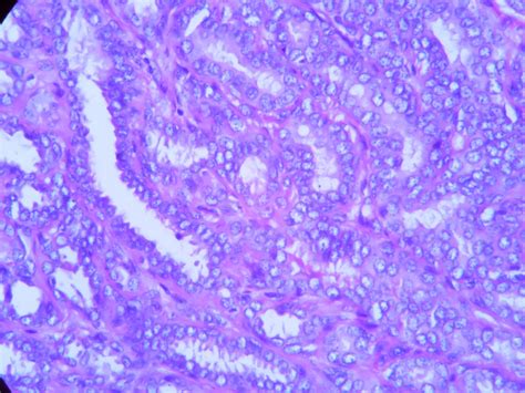 Tubular adenoma – Histopathology.guru