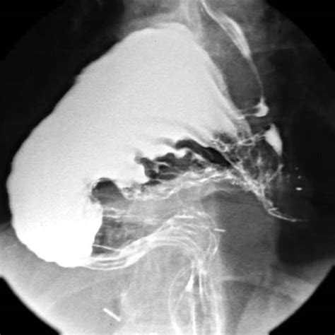 Gastric Volvulus | Radiology Key