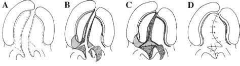 Figure 2 from Palatoplasty: evolution and controversies. | Semantic Scholar