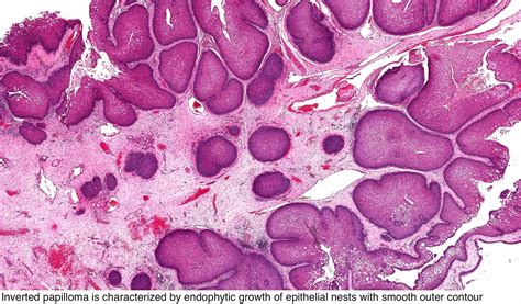 Pathology Outlines - Sinonasal papilloma