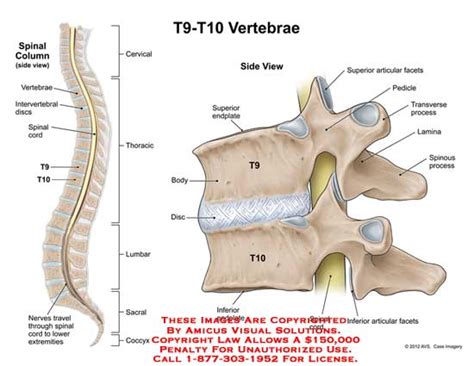 AMICUS Illustration of amicus,injury,anatomy,spinal,column,thoracic,vertebrae,intervertebral ...