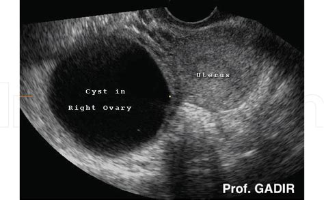 √ Ovarian Cancer Ultrasound Ovarian Cyst : Transvaginal Ultrasonography ...