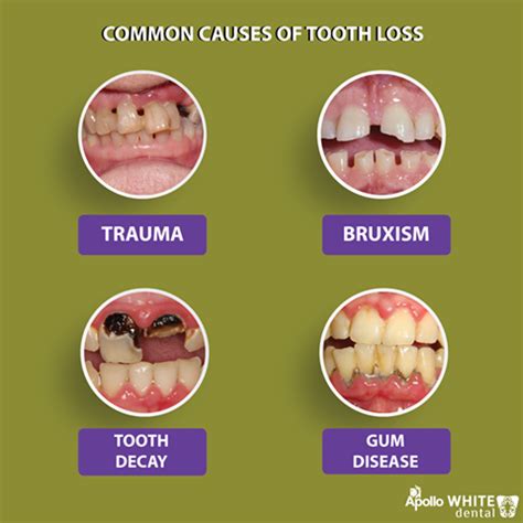 Dental and Periodontal diseases are the common causes of tooth loss ...