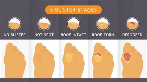 How To Treat A Blister — ScouterLife