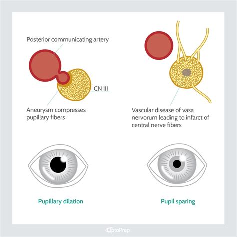 Pupil-Involved vs. Pupil-Sparing Acquired Oculomotor Nerve Palsy